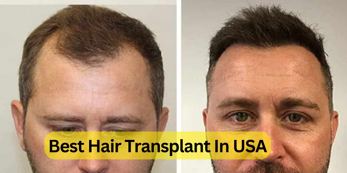 Best Hair Transplant In USA